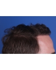 After Hair Transplant&nbsp;Front